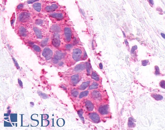 GPR48 / LGR4 Antibody - Breast, Carcinoma