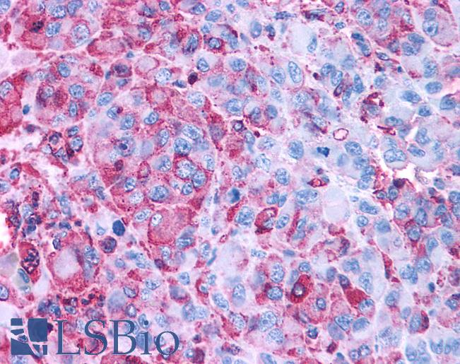 GPR50 Antibody - Anti-GPR50 antibody IHC of human Skin, Melanoma. Immunohistochemistry of formalin-fixed, paraffin-embedded tissue after heat-induced antigen retrieval.