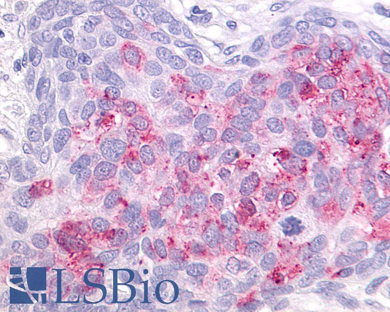 GPR55 Antibody - Anti-GPR55 antibody IHC of human Ovary, Carcinoma. Immunohistochemistry of formalin-fixed, paraffin-embedded tissue after heat-induced antigen retrieval.