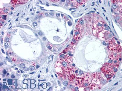 GPR6 Antibody - Lung, adenocarcinoma