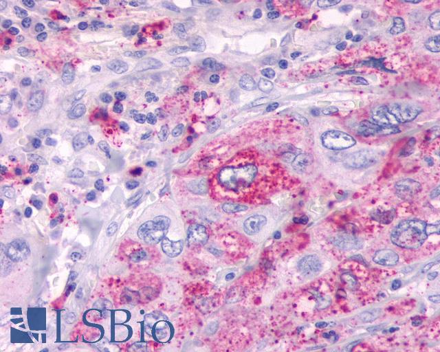 GPR61 Antibody - Lung, non small-cell carcinoma