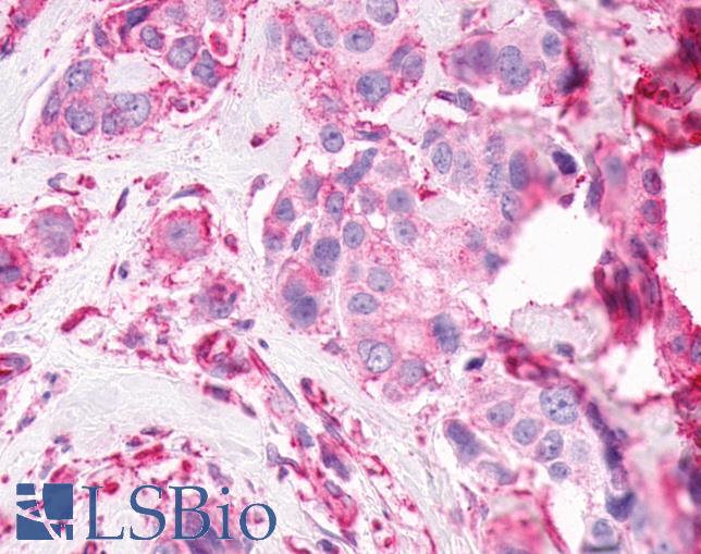 GPR61 Antibody - Breast, Carcinoma