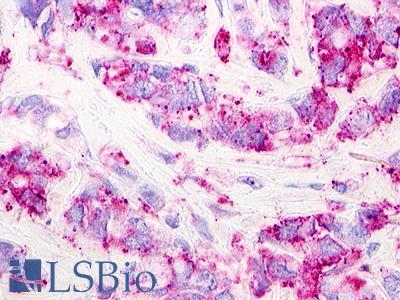 GPR62 Antibody - Breast, Carcinoma