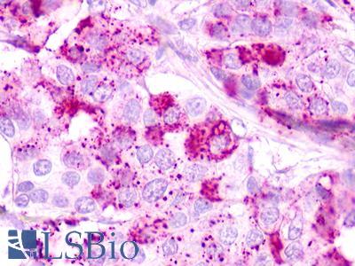 GPR62 Antibody - Breast, Infiltrating Ductal Carcinoma