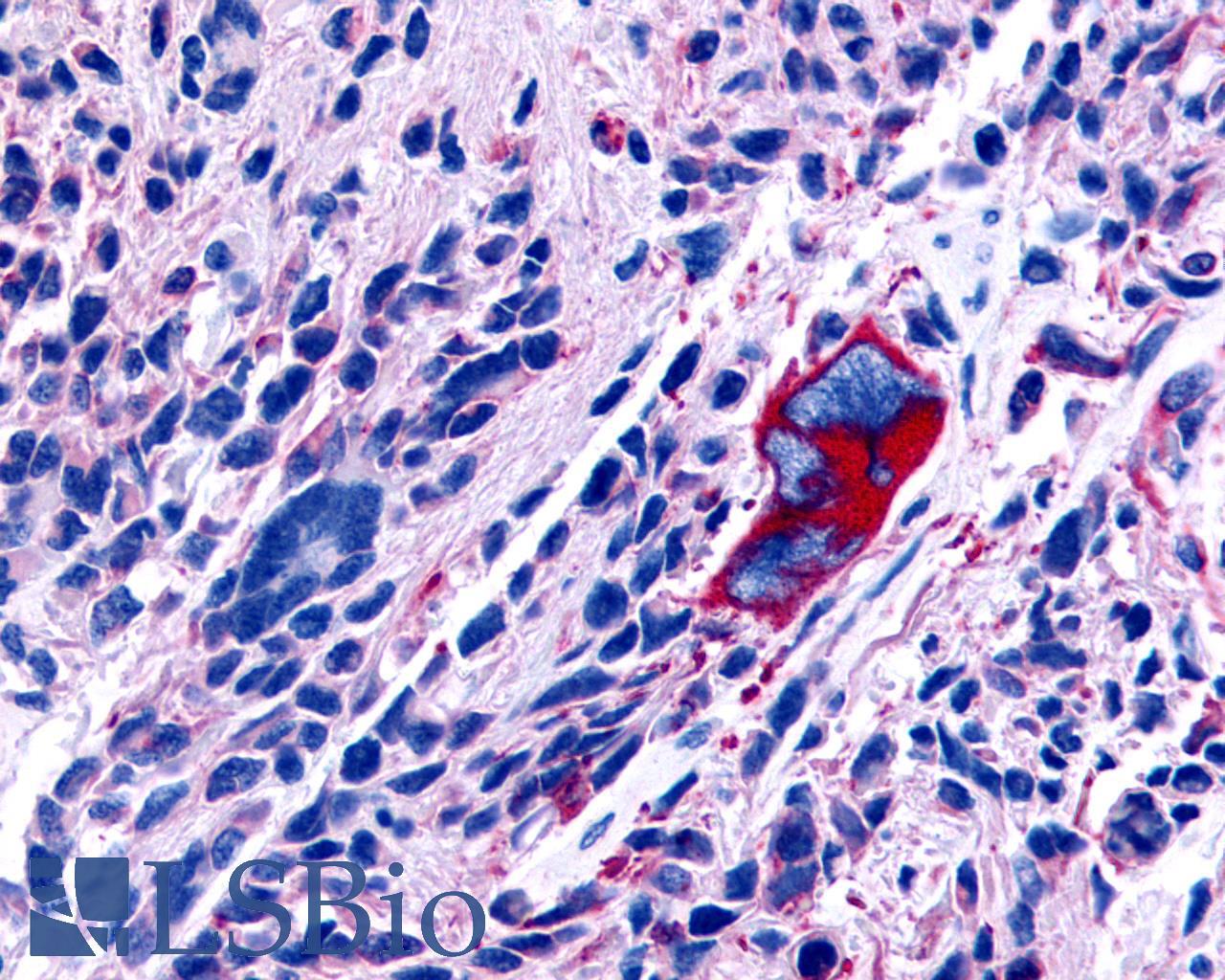 GPR63 Antibody - Brain, Glioblastoma