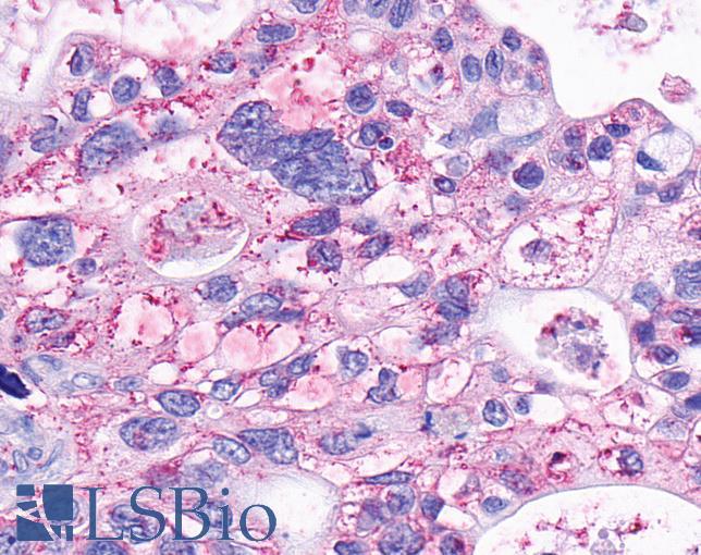 GPR63 Antibody - Pancreas, carcinoma