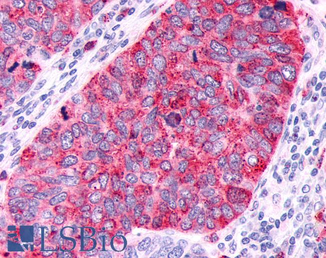 GPR63 Antibody - Anti-GPR63 antibody IHC of human Lung, Small Cell Carcinoma. Immunohistochemistry of formalin-fixed, paraffin-embedded tissue after heat-induced antigen retrieval.