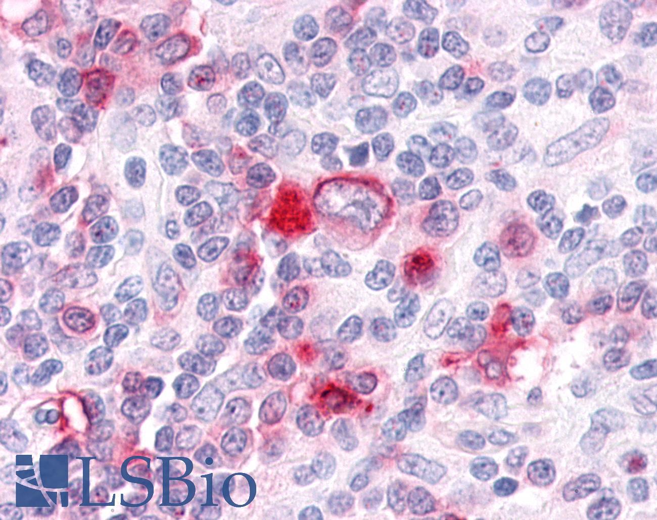 GPR63 Antibody - Hodgkin's Lymphoma