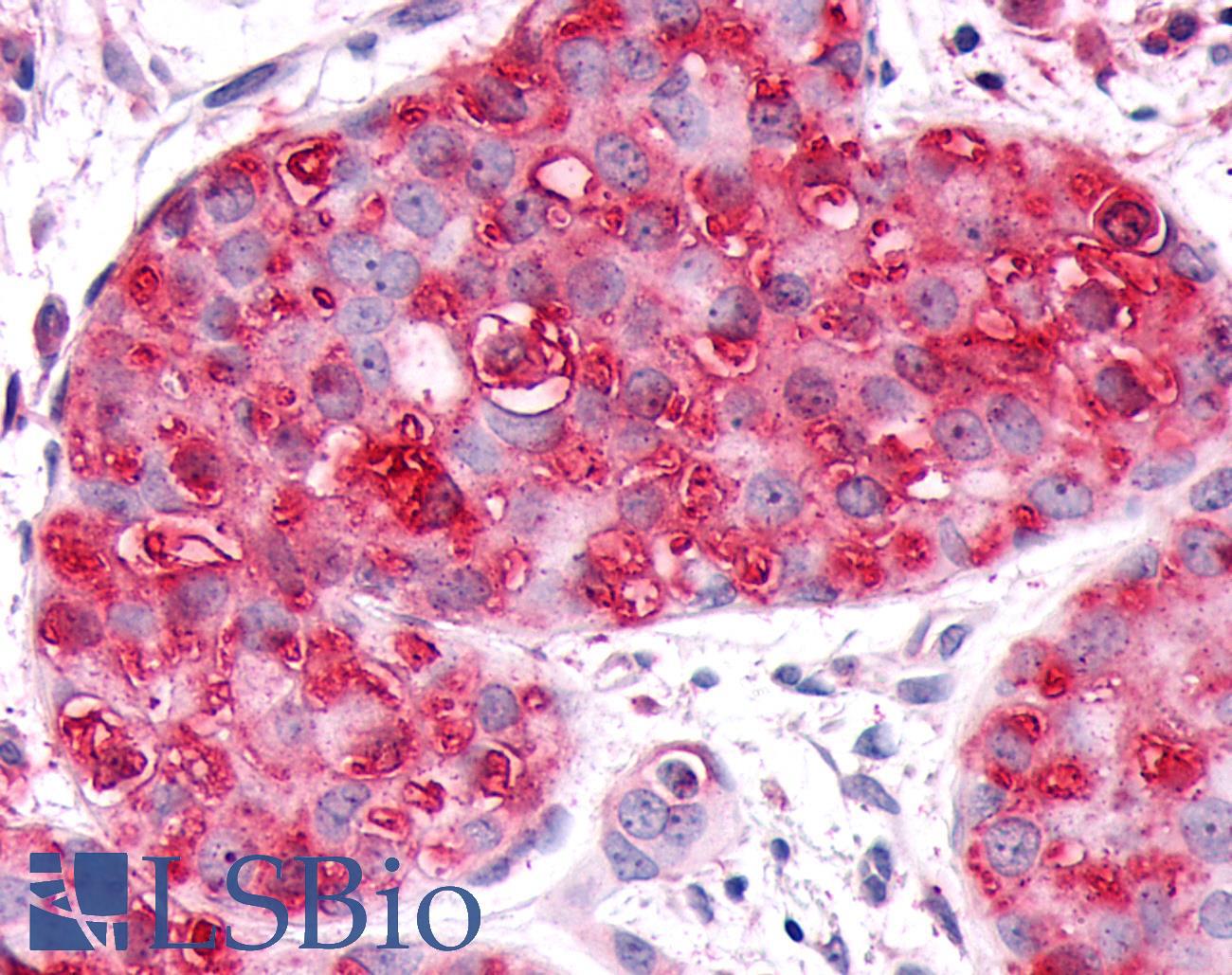 GPR63 Antibody - Breast, Carcinoma