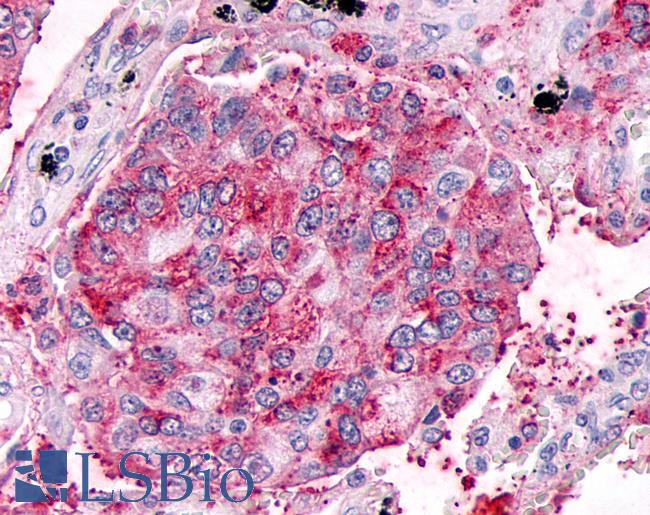 GPR63 Antibody - Lung, Non Small-Cell Carcinoma