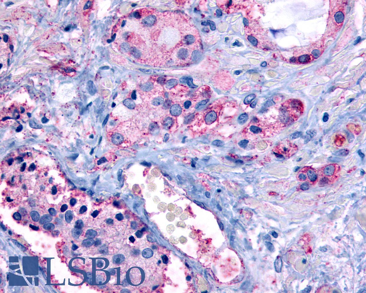 GPR65 / TDAG8 Antibody - Prostate, carcinoma