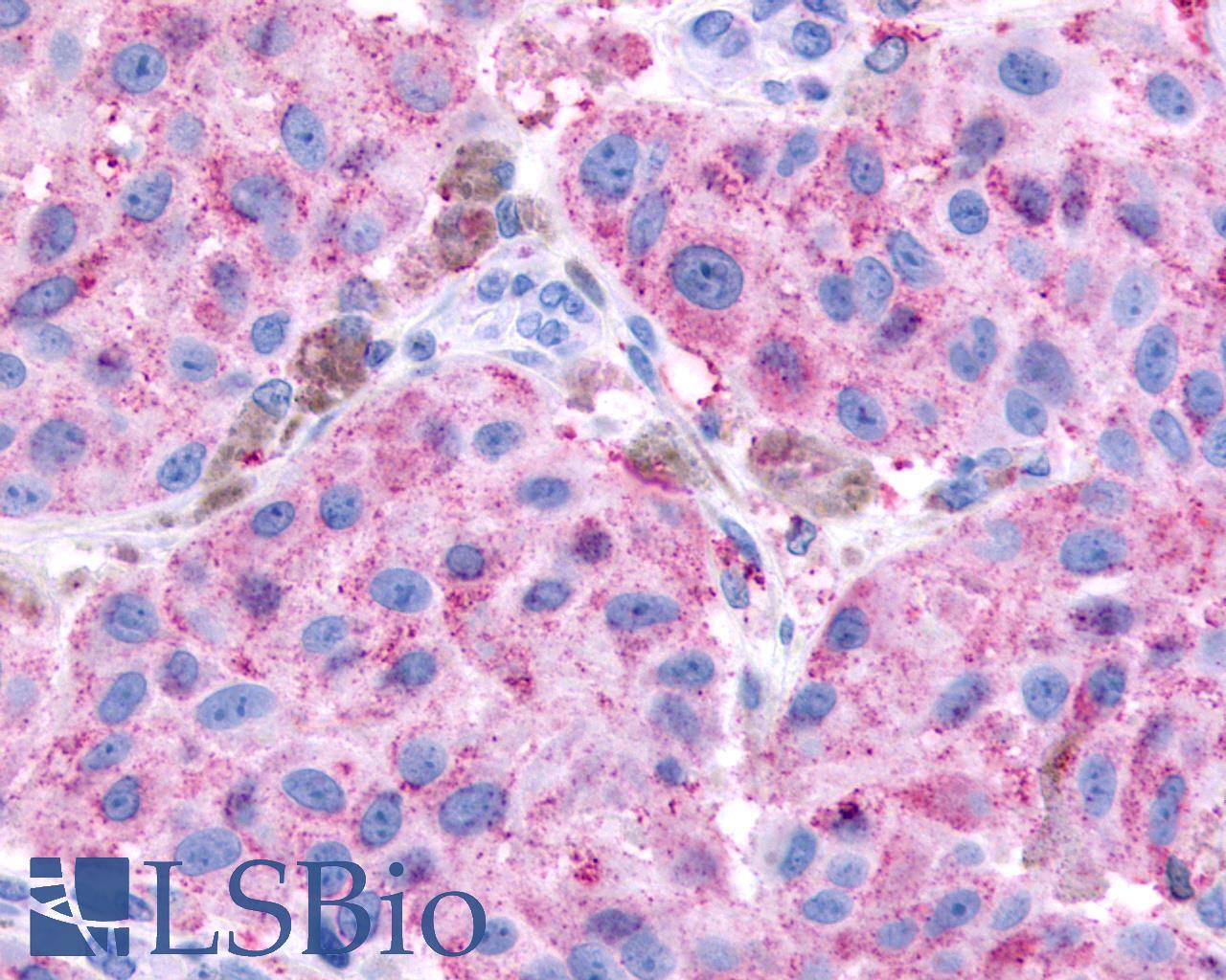 GPR65 / TDAG8 Antibody - Skin, Malignant Melanoma