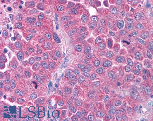 GPR80 / GPR99 / OXGR1 Antibody - Anti-GPR80 / GPR99 / OXGR1 antibody IHC of human Lung, Non-Small Cell Carcinoma. Immunohistochemistry of formalin-fixed, paraffin-embedded tissue after heat-induced antigen retrieval.