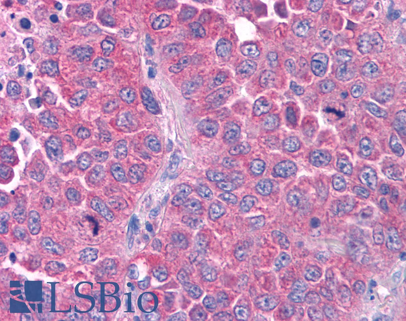 GPR80 / GPR99 / OXGR1 Antibody - Anti-GPR80 / GPR99 / OXGR1 antibody IHC of human Lung, Non-Small Cell Carcinoma. Immunohistochemistry of formalin-fixed, paraffin-embedded tissue after heat-induced antigen retrieval.