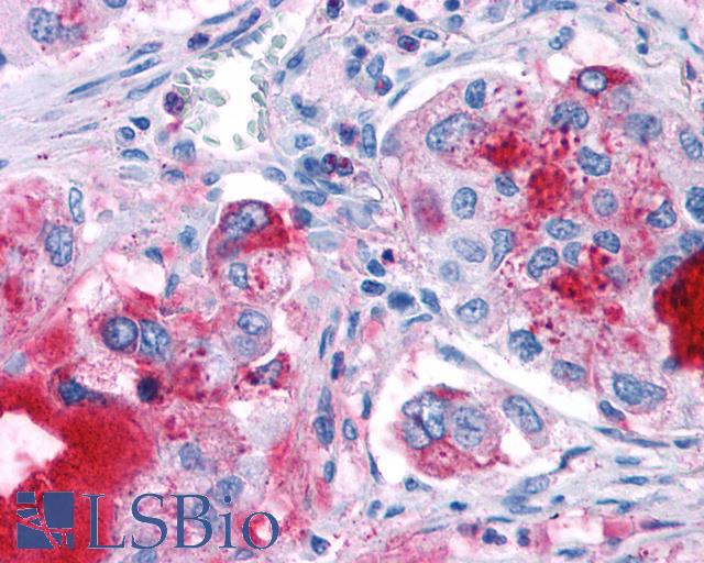 GPR82 Antibody - Lung, non small-cell carcinoma