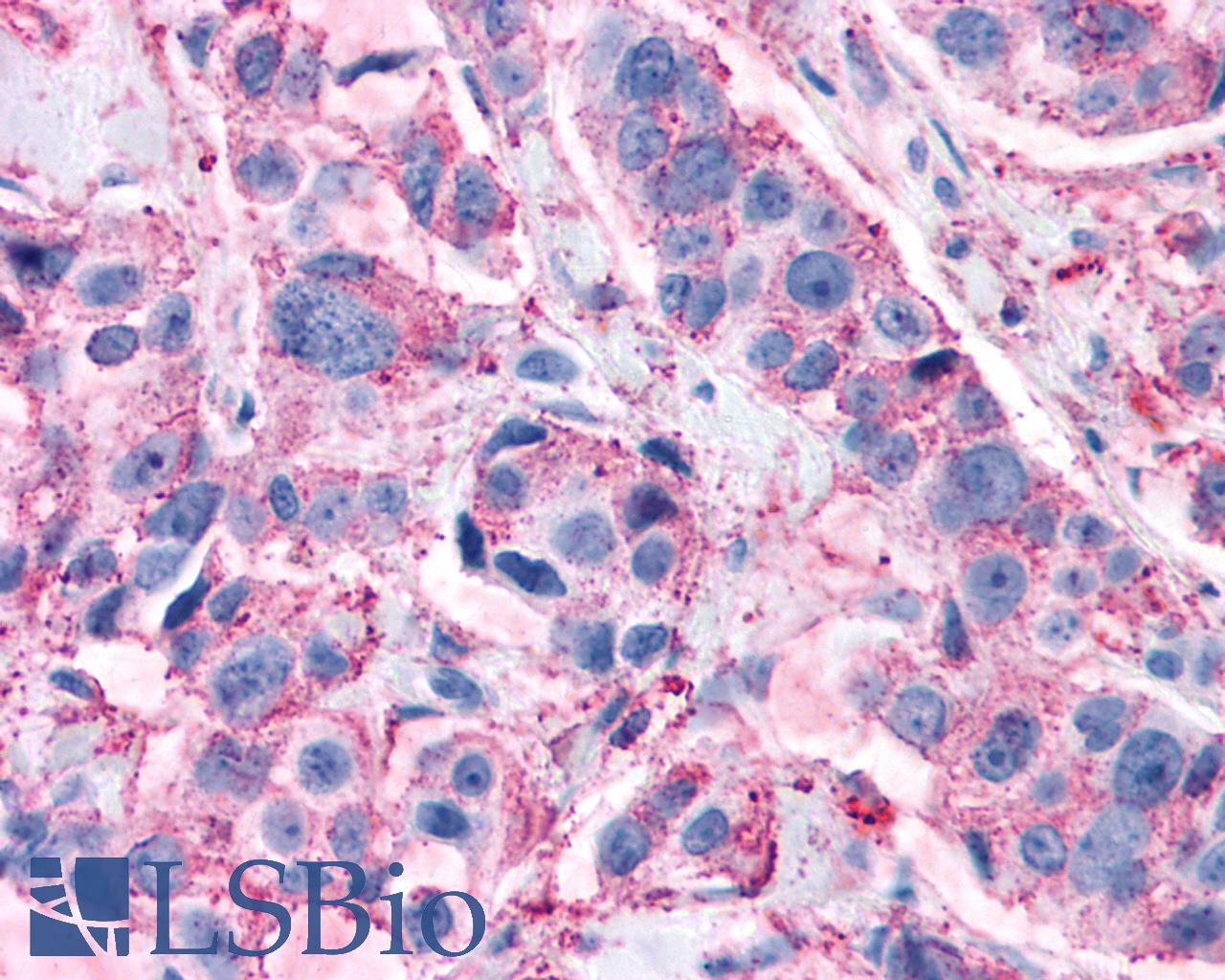 GPR82 Antibody - Breast, Carcinoma