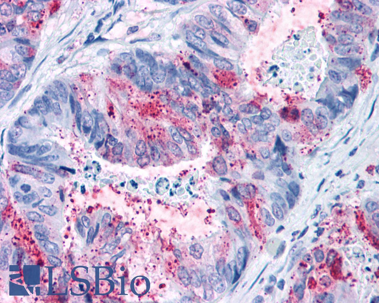 GPR82 Antibody - Colon carcinoma