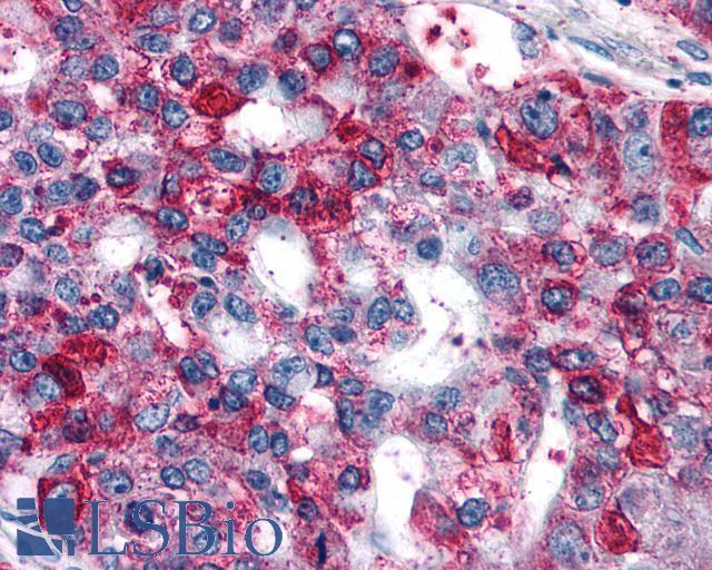 GPR82 Antibody - Lung, Non Small-Cell Carcinoma