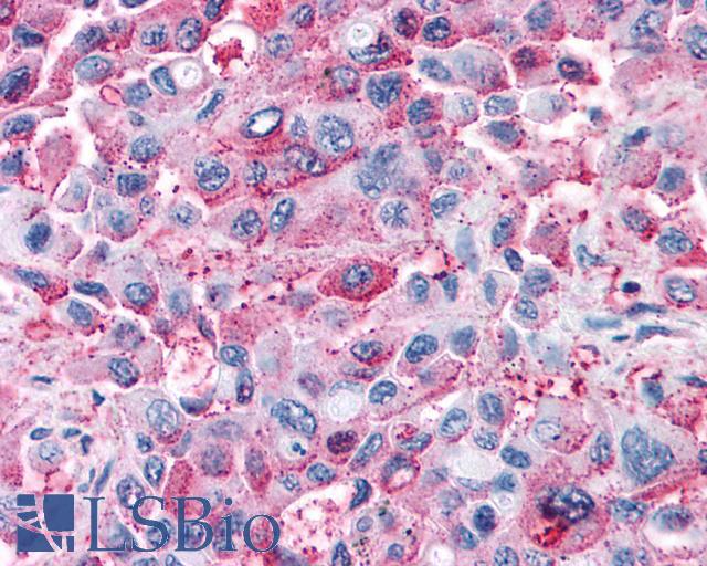 GPR82 Antibody - Pancreas, carcinoma