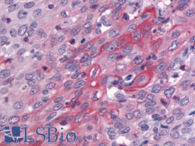 GPR83 Antibody - Lung, Adenocarcinoma