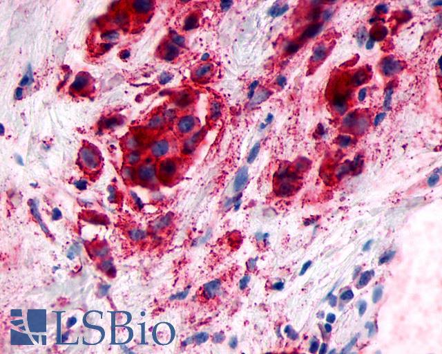 GPR89A Antibody - Breast, Carcinoma