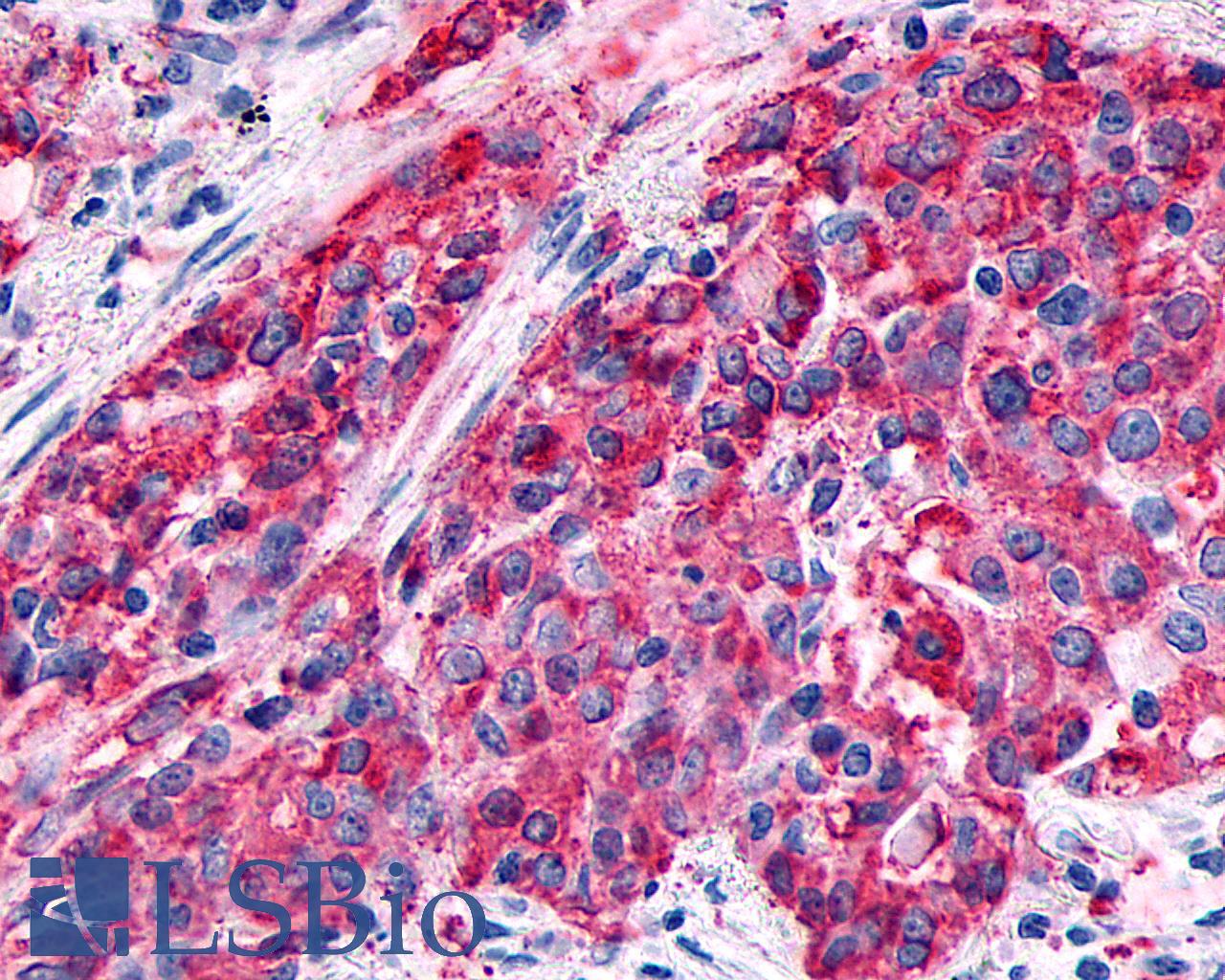 GPR89A Antibody - Lung, non small-cell carcinoma