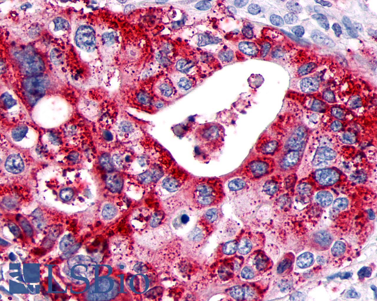 GPR89A Antibody - Pancreas, carcinoma