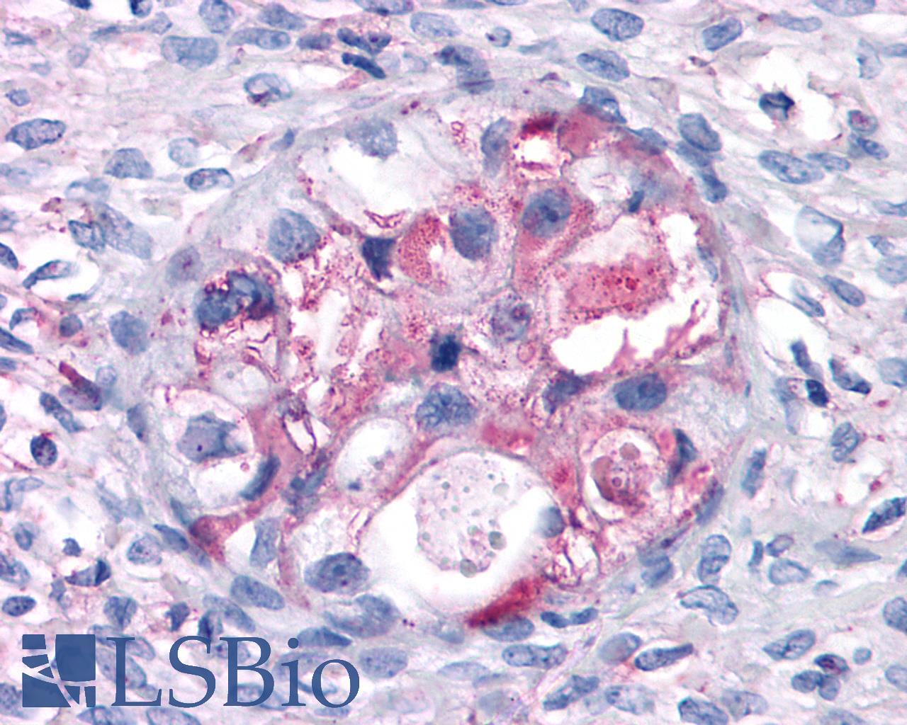 GPRC5A / RAI3 Antibody - Ovary, Carcinoma