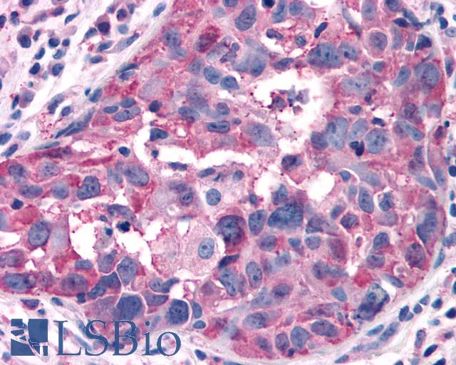 GPRC5A / RAI3 Antibody - Breast, Carcinoma