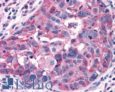 GPRC5A / RAI3 Antibody - Breast, Carcinoma