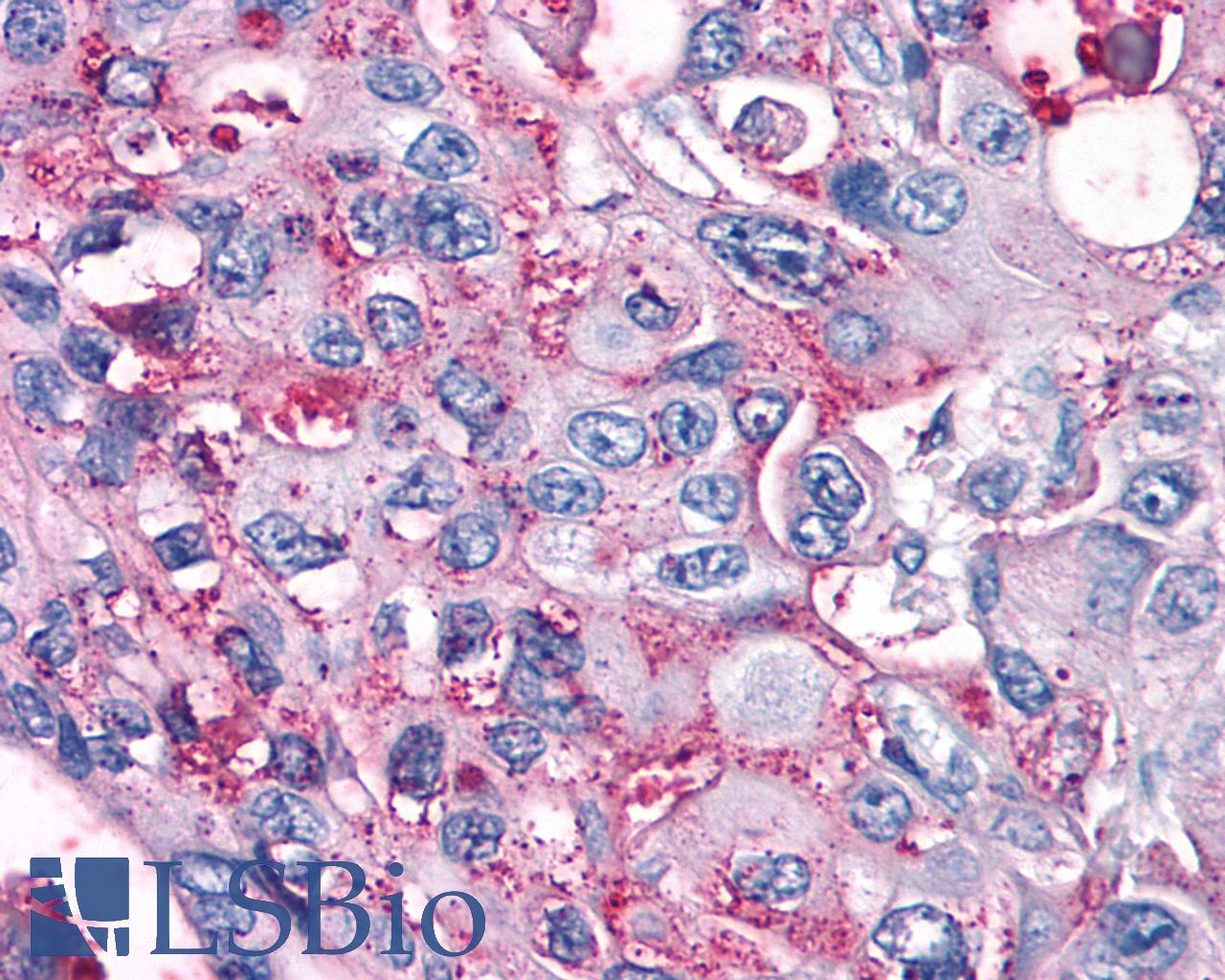 GPRC5A / RAI3 Antibody - Anti-GPRC5A / RAI3 antibody IHC of human Pancreas, Carcinoma. Immunohistochemistry of formalin-fixed, paraffin-embedded tissue after heat-induced antigen retrieval.