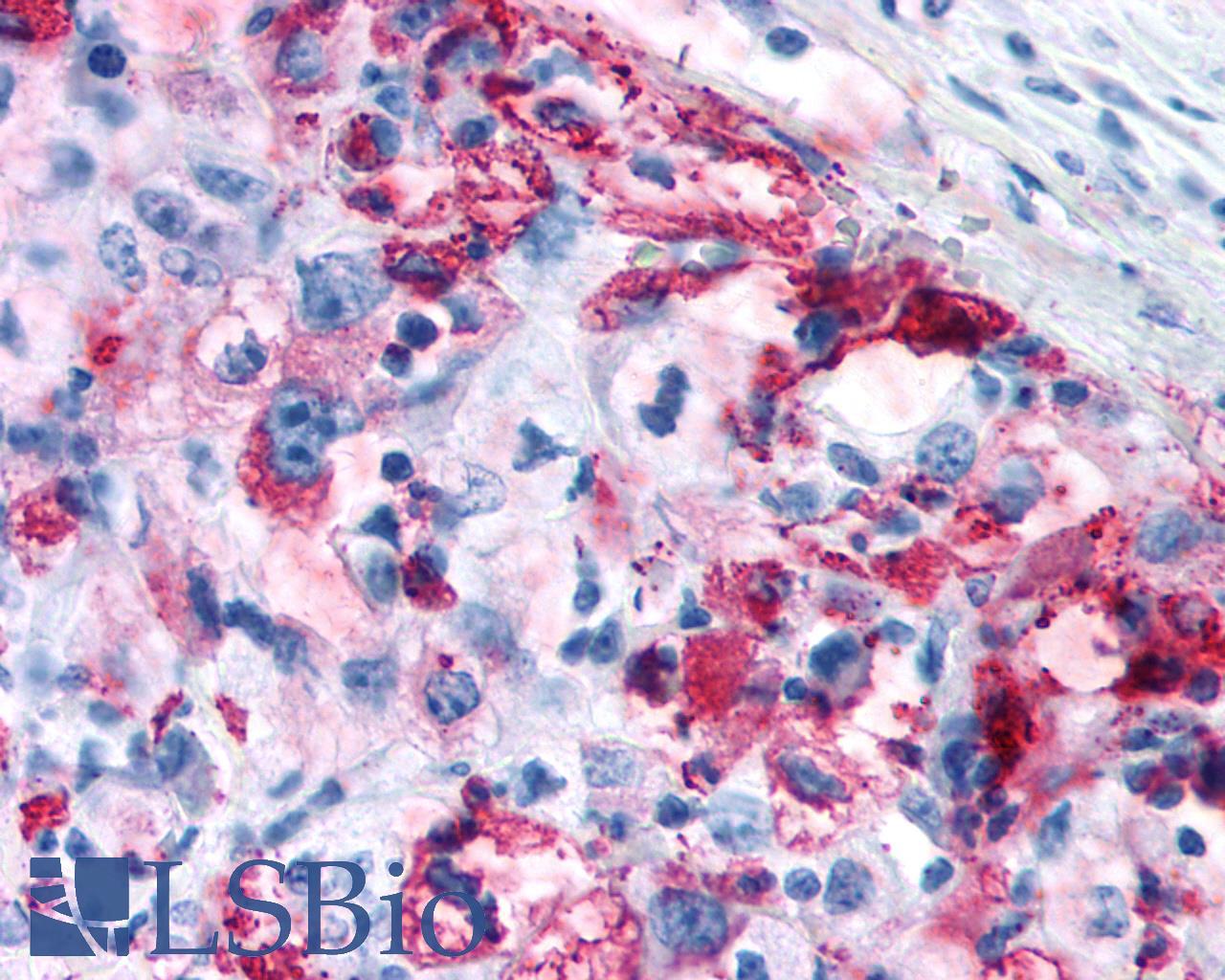 GPRC5A / RAI3 Antibody - Lung, Non Small-Cell Carcinoma