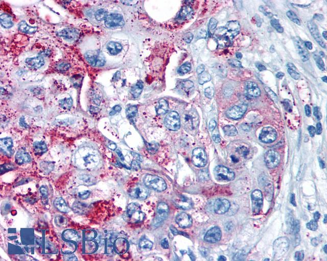 GPRC5A / RAI3 Antibody - Anti-GPRC5A / RAI3 antibody IHC of human Pancreas, Carcinoma. Immunohistochemistry of formalin-fixed, paraffin-embedded tissue after heat-induced antigen retrieval.