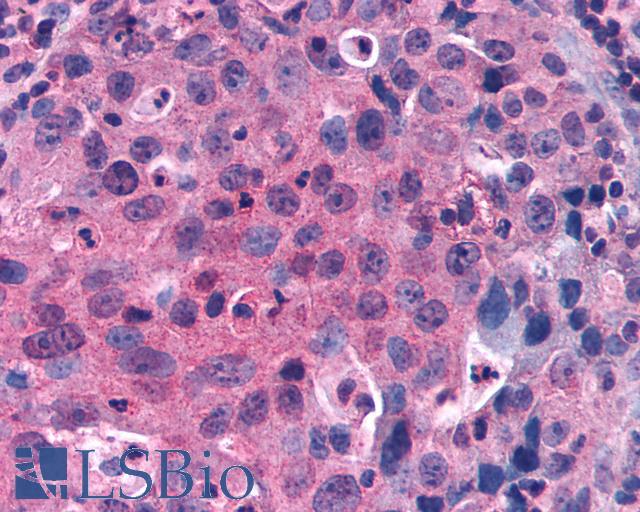 GPRC5C Antibody - Lung non small-cell carcinoma