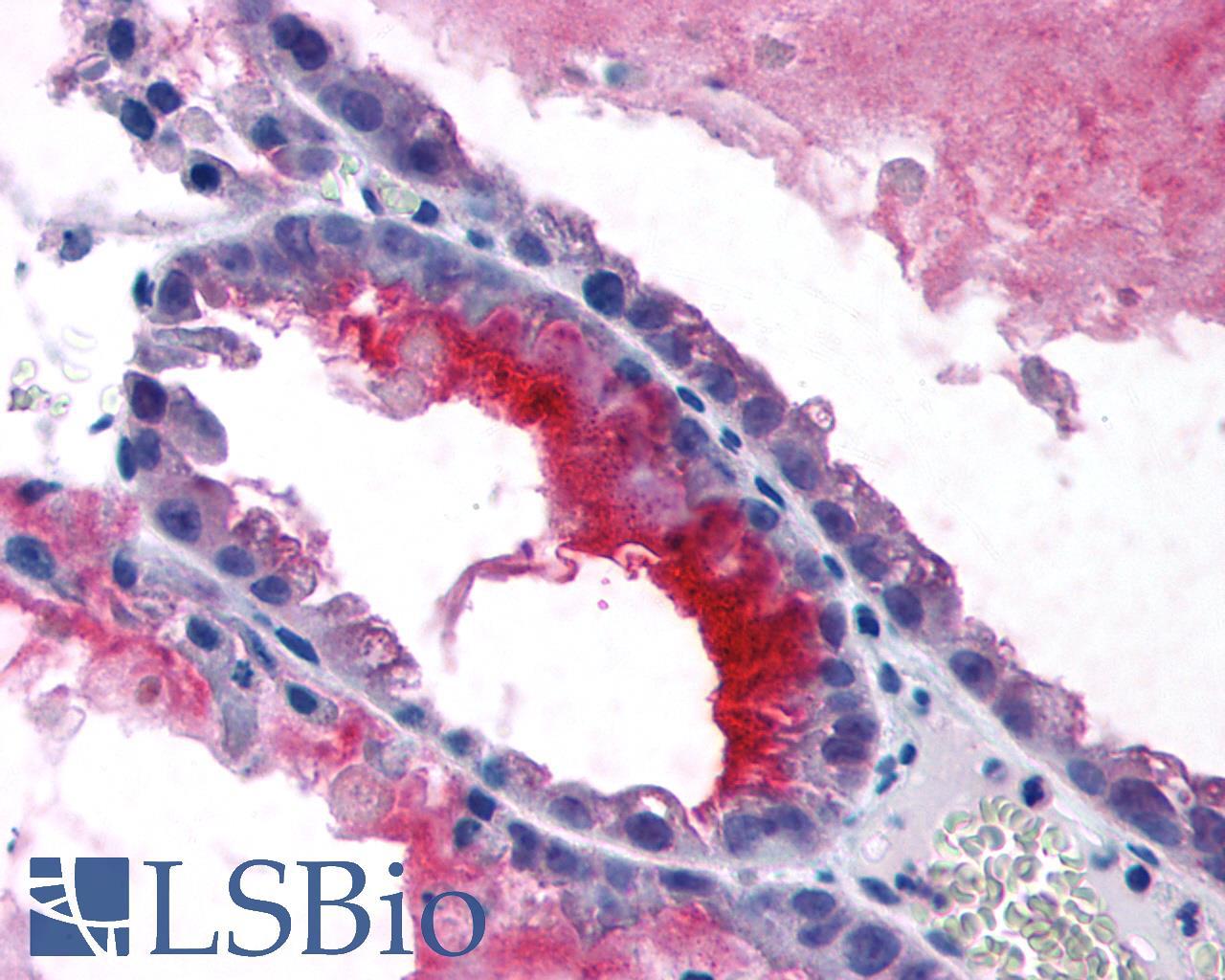 GPRC5C Antibody - Ovary, carcinoma