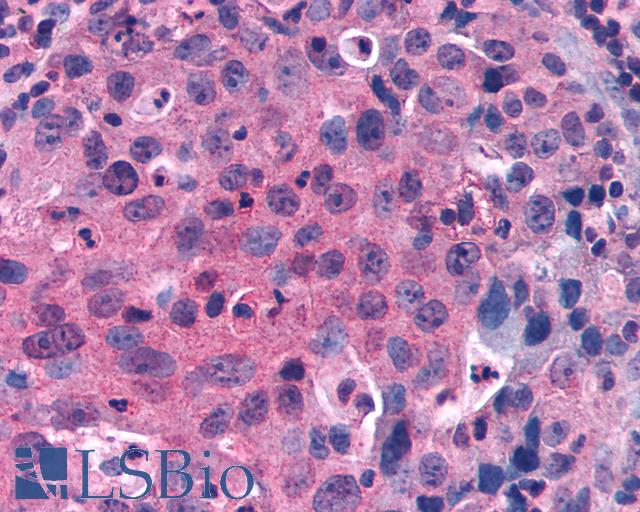 GPRC5C Antibody - Lung, Non Small-Cell Carcinoma