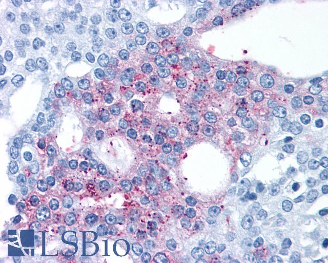 GPRC6A Antibody - Anti-GPRC6A antibody IHC of human Prostate, Carcinoma. Immunohistochemistry of formalin-fixed, paraffin-embedded tissue after heat-induced antigen retrieval.