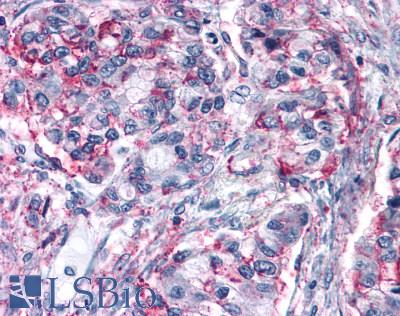 GPRC6A Antibody - Lung, non small cell carcinoma