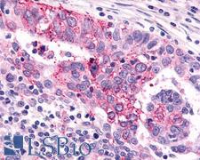 GRM6 / MGLUR6 Antibody - Anti-GRM6 / MGLUR6 antibody IHC of human Ovary, Carcinoma. Immunohistochemistry of formalin-fixed, paraffin-embedded tissue after heat-induced antigen retrieval.