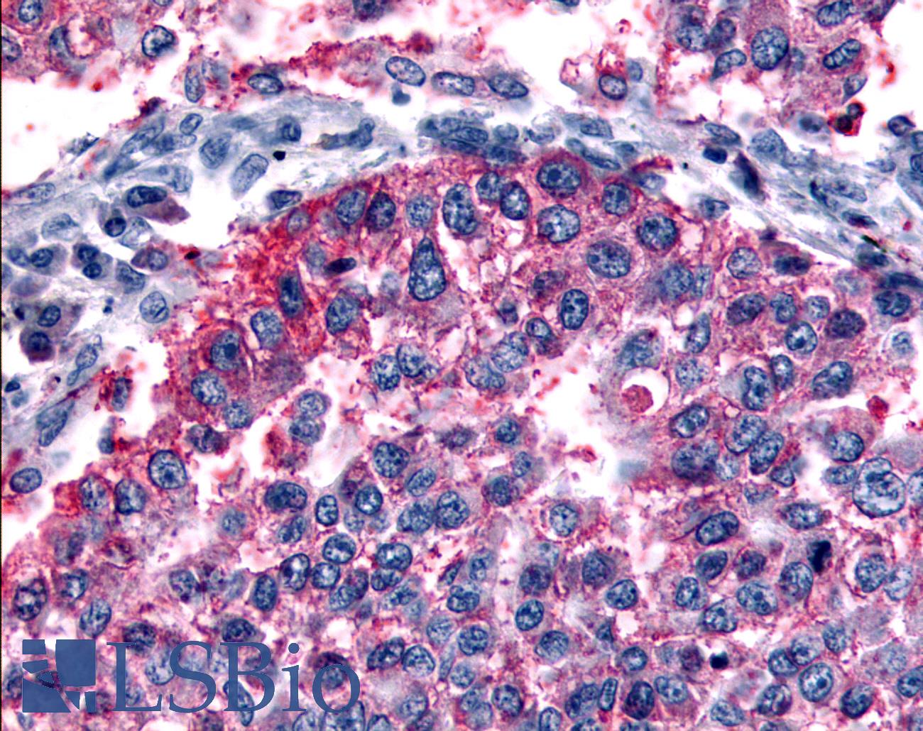 GRM6 / MGLUR6 Antibody - Anti-GRM6 / MGLUR6 antibody IHC of human Lung, Non-Small Cell Carcinoma. Immunohistochemistry of formalin-fixed, paraffin-embedded tissue after heat-induced antigen retrieval.