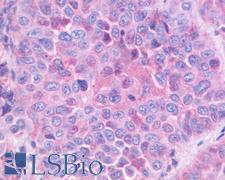 GRPR Antibody - Anti-GRPR antibody IHC of human Lung, Non-Small Cell Carcinoma. Immunohistochemistry of formalin-fixed, paraffin-embedded tissue after heat-induced antigen retrieval.