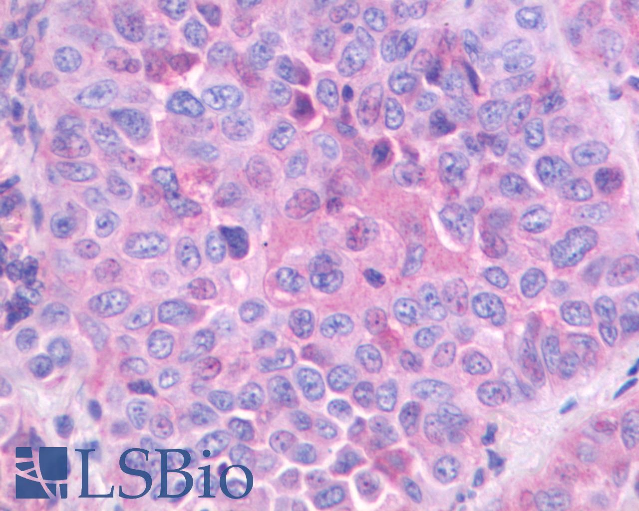 GRPR Antibody - Anti-GRPR antibody IHC of human Lung, Non-Small Cell Carcinoma. Immunohistochemistry of formalin-fixed, paraffin-embedded tissue after heat-induced antigen retrieval.