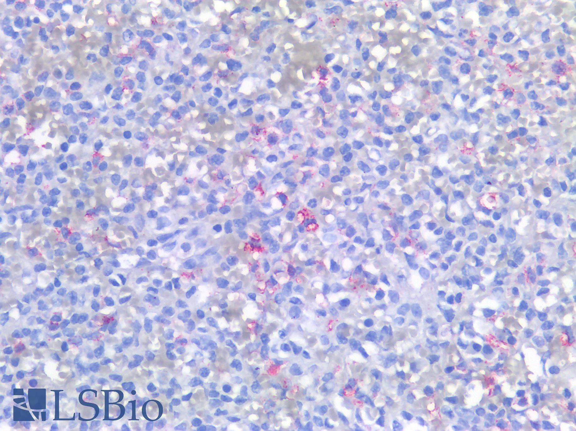 Hairy Cell Leukemia Antibody - Human Spleen, Hairy Cell Lukemia: Formalin-Fixed, Paraffin-Embedded (FFPE)