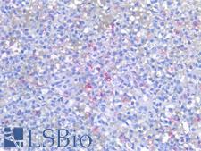 Hairy Cell Leukemia Antibody - Human Spleen, Hairy Cell Lukemia: Formalin-Fixed, Paraffin-Embedded (FFPE)