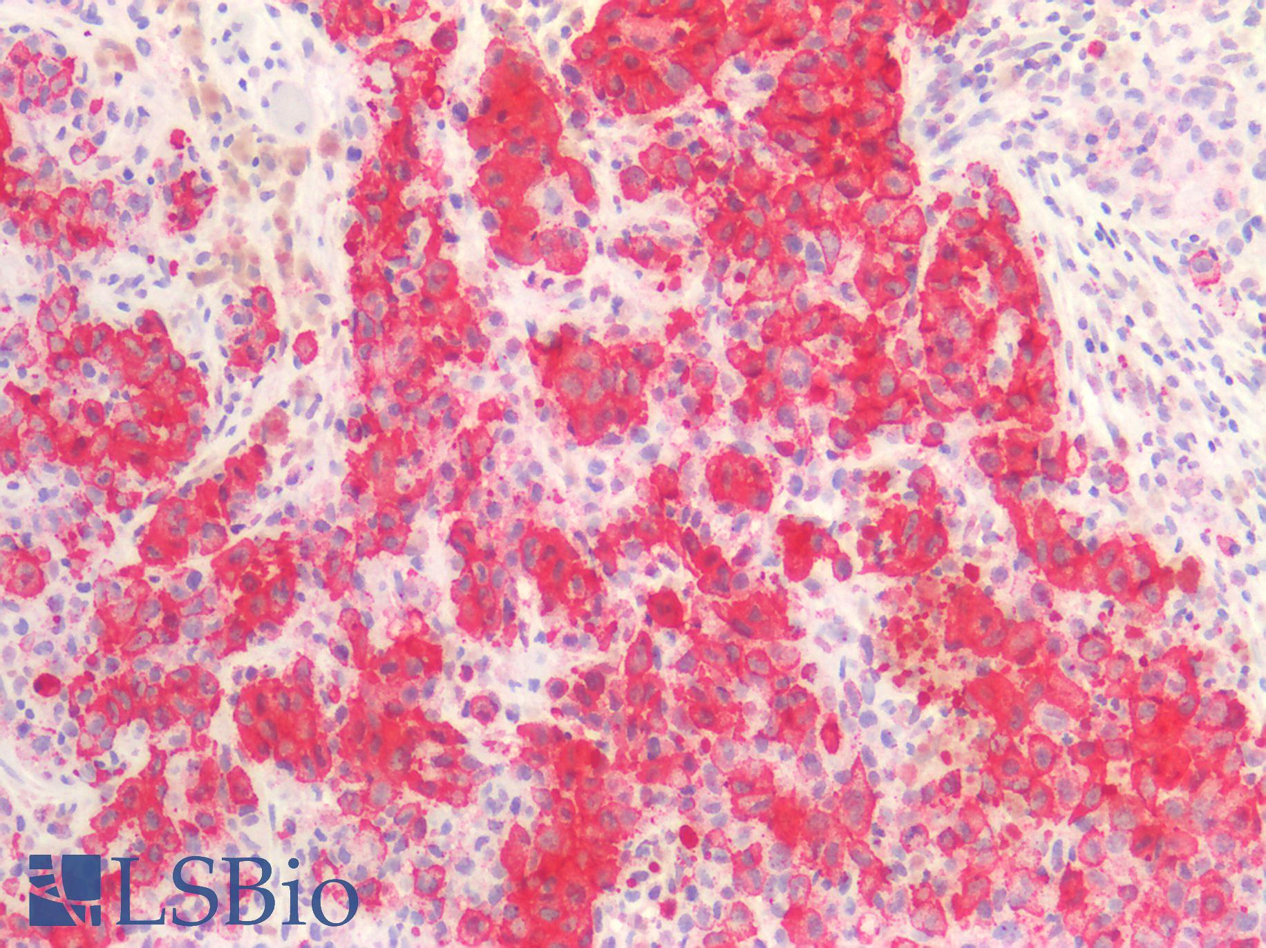 HMB45 Antibody - Human Skin, Melanoma: Formalin-Fixed, Paraffin-Embedded (FFPE)