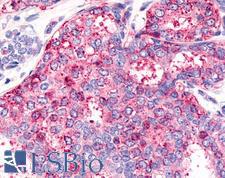 HNF4G / HNF4 Gamma Antibody - Breast, Carcinoma