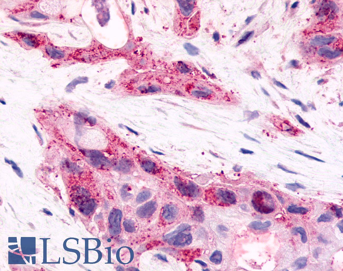 HNF4G / HNF4 Gamma Antibody - Pancreas, carcinoma