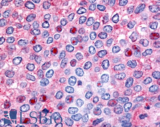 HNF4G / HNF4 Gamma Antibody - Anti-HNF4G / HNF4 Gamma antibody IHC of human Breast, Carcinoma. Immunohistochemistry of formalin-fixed, paraffin-embedded tissue after heat-induced antigen retrieval.