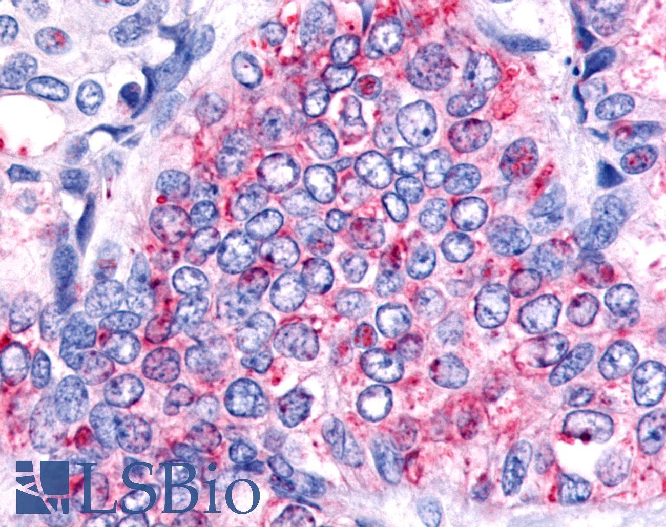 HNF4G / HNF4 Gamma Antibody - Breast, Carcinoma