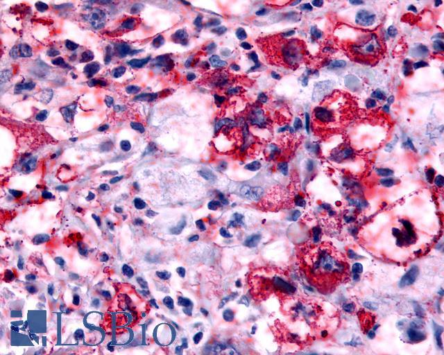 HRH4 / Histamine H4 Receptor Antibody - Lung, Non Small-Cell Carcinoma